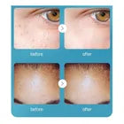 Crema Anti Verrugas